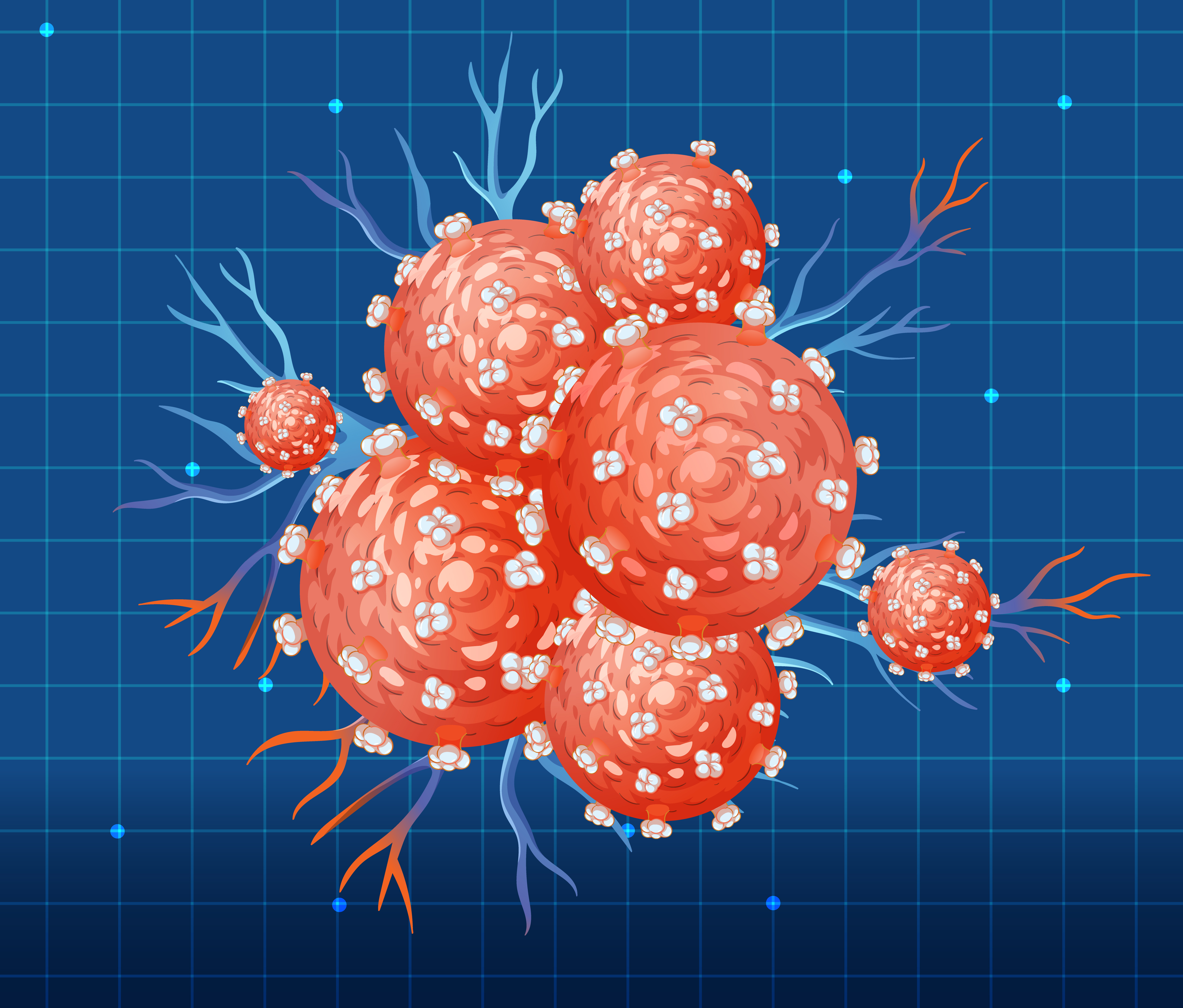 Rectal cancer stages: what stage I, II, III and IV mean